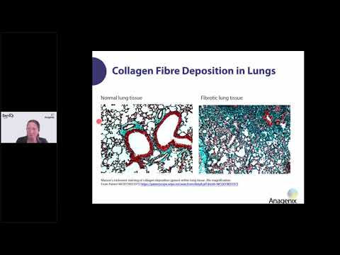 Lung Fibrosis  - Lasting lung damage from infection, inflammation and other lung diseases