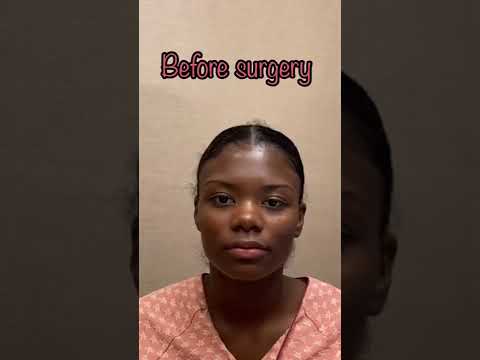 6months plastic surgery update!!