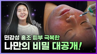 줄기세포 피부주사 ｜ 수부지 민감성 안면홍조 피부 타입이 받아본 줄기세포 피부주사 , 2달차 효과 & 통증 체크