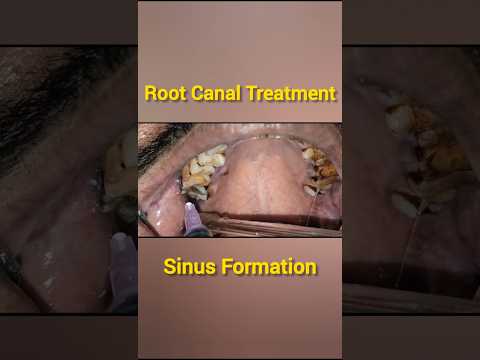 Root canal treatment|RCT|