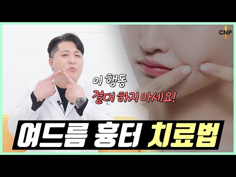 여드름을 해결해도 끝이 아니다! 더 스트레스를 주는 여드름 흉터 해결방법!!