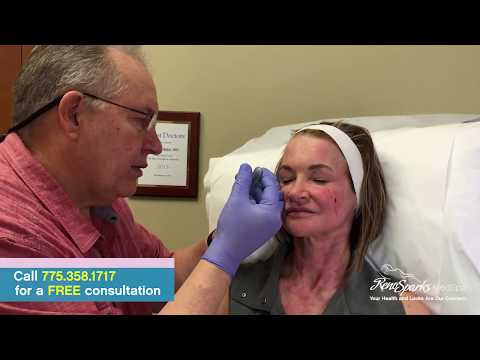 Juvederm Facial Rejuvenation - Reno Sparks MedSpa - Dr. Calvin Van Reken