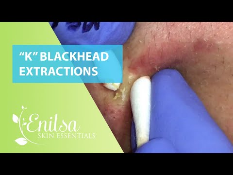 "K" Blackhead Extractions