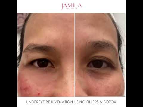 Jamila Aesthetics - Under Eye Rejuvenation using Fillers and Botox