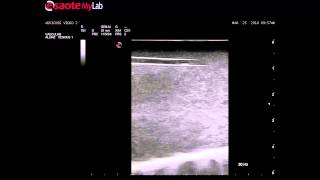 超音波訓練教學＿血管超音波硬化治療訓練模型 Advanced Sclerotherapy Ultrasound Training Model