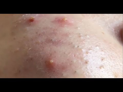 Deep Whiteheads Removal, Milia, Skill Acne Remove 2019