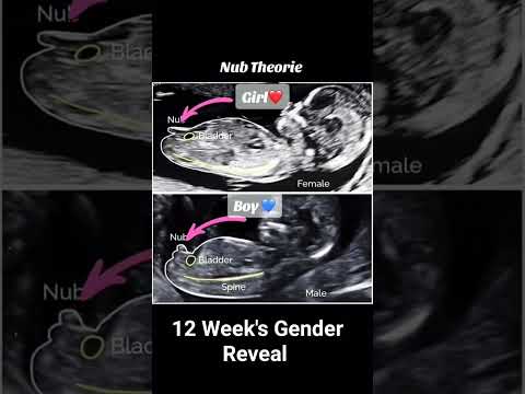 12 Week's Nub theory Gender Reveal ultrasound scan #genderpredictions #babyultrasound