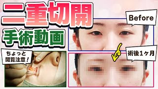 【二重全切開の手術動画】ダウンタイムの経過もあり 水の森美容クリニックの二重全切開【閲覧注意】