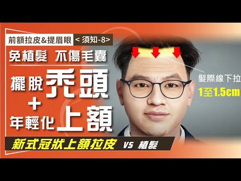 前額拉皮&提眉眼（須知-8）瀏海髮片檔不住風吹的"禿"然"社死現場"  抬頭紋/眉毛下垂/高髮線交給新式冠狀上額拉皮  髮際線下拉增量免植髮 40-20241225