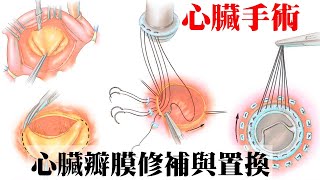 心臟衰竭手術：什麼是心臟瓣膜修補與置換｜許原彰醫師