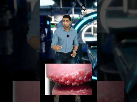 ஆணுறுப்புக்குள் சிறு பருக்களா? Pearly penile papules- Dr. Isacc Abbas