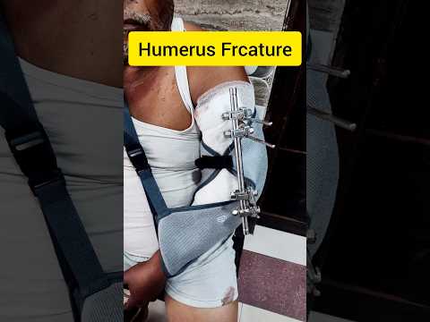 Humerus Displaced Frcature 3D