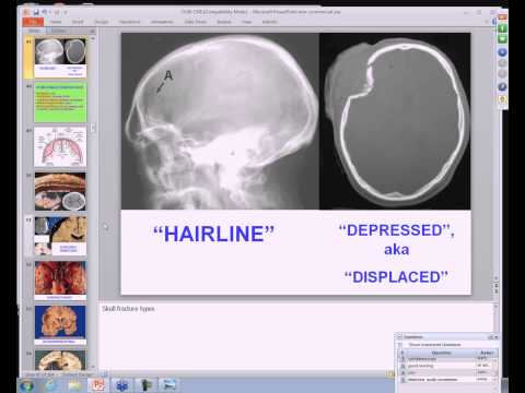 Medical School Pathology, 2013 Season, Session #41: CNS-I