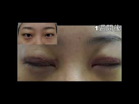 30代女性　全切開二重手術　#shorts