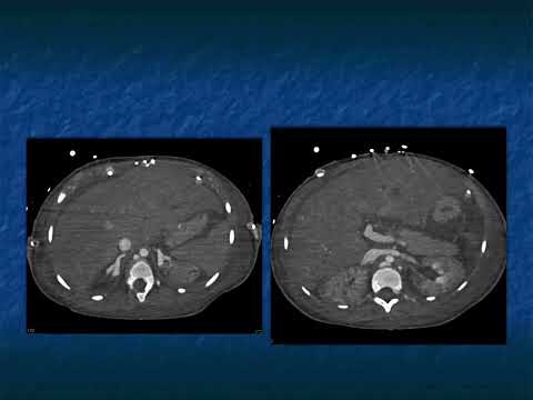 The Differential Diagnosis of Loss of Renal Corticomedullary Interface - Part 3