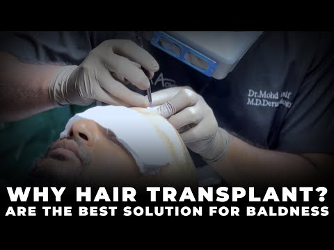 Why Hair Transplants are the Best Solution for Baldness | Trichometric Sapphire FUE | Cara Clinic