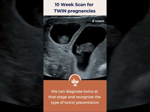 10 Week Scan for Twins.