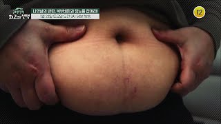 나잇살의 반란, 복부비만과 당뇨를 잡아라!_글로벌 힐링 최고의 선택 30회 예고 TV CHOSUN 220122 방송