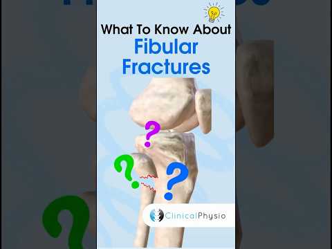 Fibular Fractures #anatomy #physiotherapy #physicaltherapy #fibulafracture