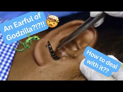 An Earful of Godzilla?!??! How to deal with a bug stuck inside the ear!