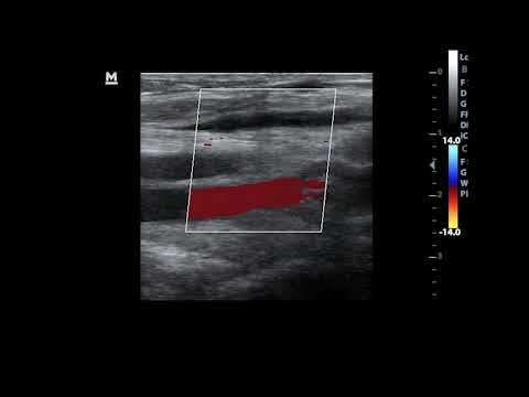 Popliteal vein Insuficiency with reflux. Abnormal perforator fron TP trunk to great saphenous vein