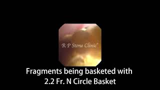 Multiple Kidney Stones treated by RIRS | R P Stone Clinic #shorts #kidneystonetreatment #rirs