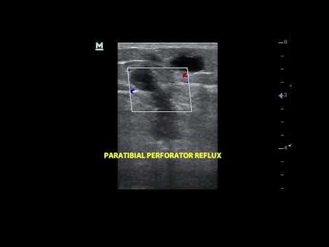 Paratibial perforator incompetence with reflux