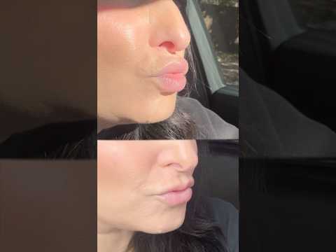 🌟BEFORE AND AFTERS OF MY LIP FILLER DISSOLVED🌟 #vlog #lipfiller #dayinthelife #atx #beforeandafter