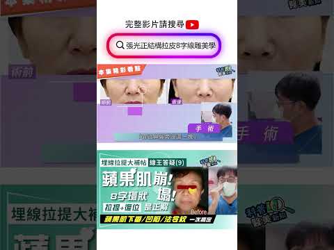 埋線拉提大補帖｜線王答疑(9)「蘋果肌拉提+復位」8字環狀深層拉提  中臉老化難題一次搞定！　蘋果肌"挺起來" 同步改善眼下凹陷/消滅法令紋 科普醫美新知366-20241101