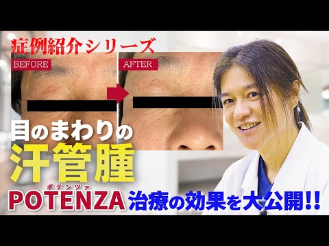 【症例紹介シリーズ】大反響の『汗管腫』！！POTENZA(ポテンツァ)での治療の実際の症例を紹介！