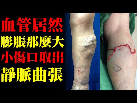 血管居然可以膨脹那麼大！小傷口取出靜脈曲張｜許原彰醫師：高雄，台南，屏東，台中靜脈曲張專科