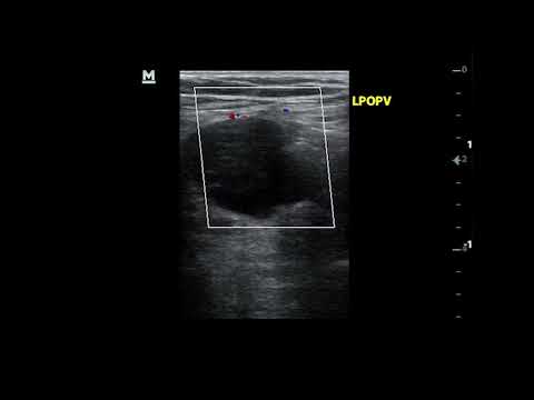 Popliteal vein aneurysm. Duplex ultrasound views