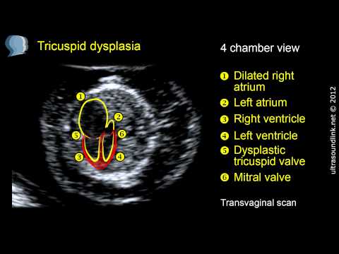 Tricuspid regurgitation (TR) in fetus:  tricuspid dysplasia at 12 week scan