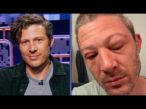 Zach Gilford Shares His SHOCKING Swollen Face After Medical Emergency