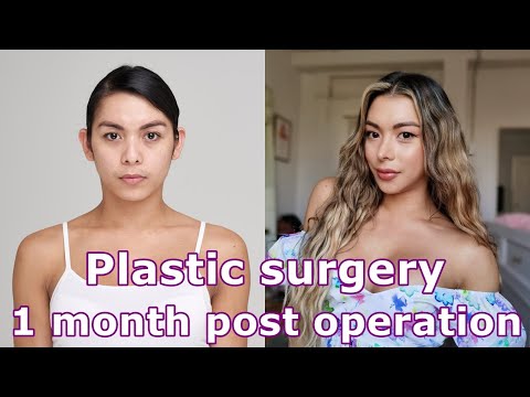 Transgender Facial Feminization surgery (FFS) in Korea : 1 month post operation review