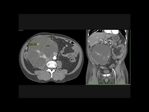 Radiology Case of the Week: The most likely diagnosis in this case is?