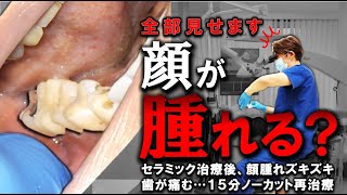 顔腫れ、ズキズキ歯が痛む！セラミック治療後になぜ？