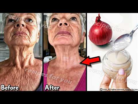 1 onion is a million times stronger than Botox, onion juice for skin wrinkles,🧅onion for face