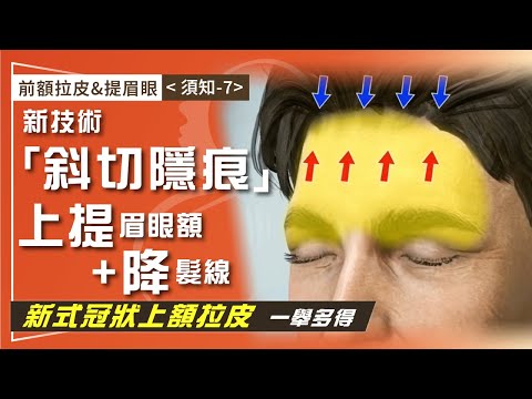 前額拉皮&提眉眼（須知-7）上額拉皮技術革新「斜切隱痕」 上提鬆弛眉眼額 同步「調降髮際線」 殲滅抬頭紋/細紋/皺眉紋 額頭年輕化一步到位！ 39-20241221