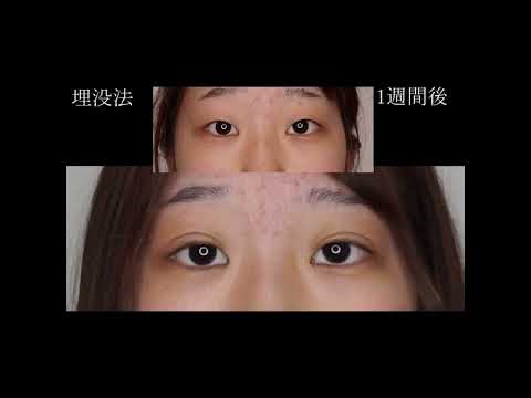 埋没法　10代女性の経過　#shorts