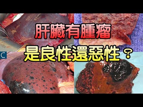 肝臟有腫瘤陰影，是良性還惡性？