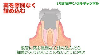 【千葉県 船橋市 歯医者】歯の根の治療　どんな治療？_いなだデンタルチャンネル005（口腔ケアチャンネル）