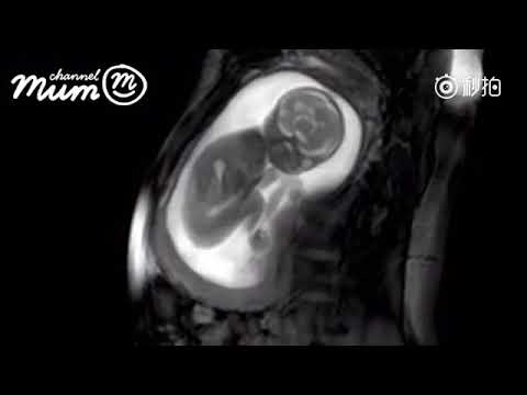 20 Weeks baby's quickening under NMR