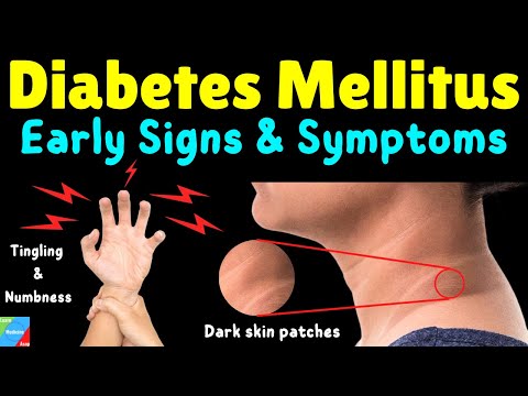 Diabetes Mellitus Signs & Symptoms | Early Signs of Diabetes Mellitus | Type 2 Diabetes