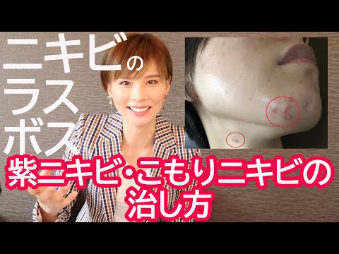 ニキビのラスボス！紫ニキビ・こもりニキビ・しこりニキビ（粉瘤）を治す唯一の方法とは？