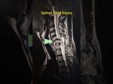 Spinal Cord Injury