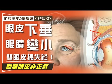 前額拉皮&提眉眼（須知-3） 眼皮下垂 眼睛變小 雙眼皮搞失蹤！ 割雙眼皮非正解  你應該這樣做～37-20241206