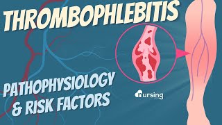 Thrombophlebitis: Pathophysiology & Risk Factors- Nursing