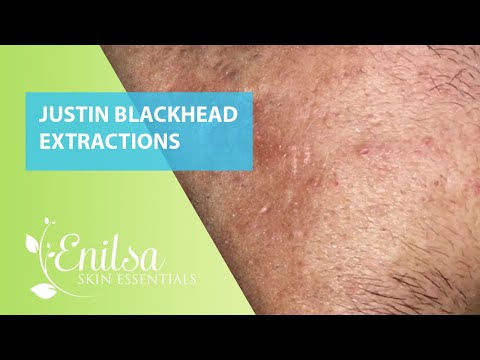 Blackheads Extractions Justin 1st Treatment