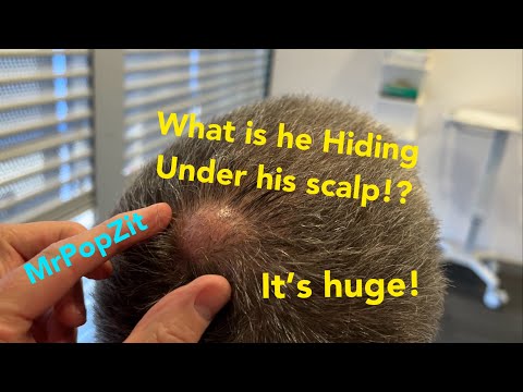 Very large 20 year old scalp bump completely  removed. Must see Bumpy lobulated sac.